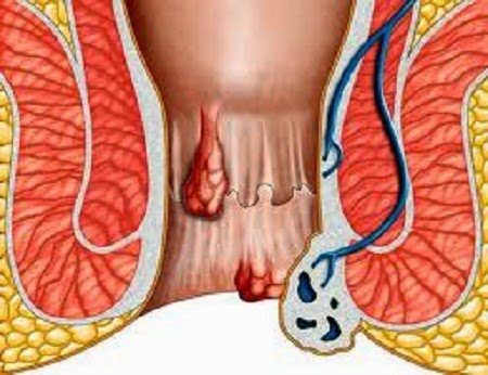 5 sai lầm ngớ ngẩn khi điều trị bệnh trĩ